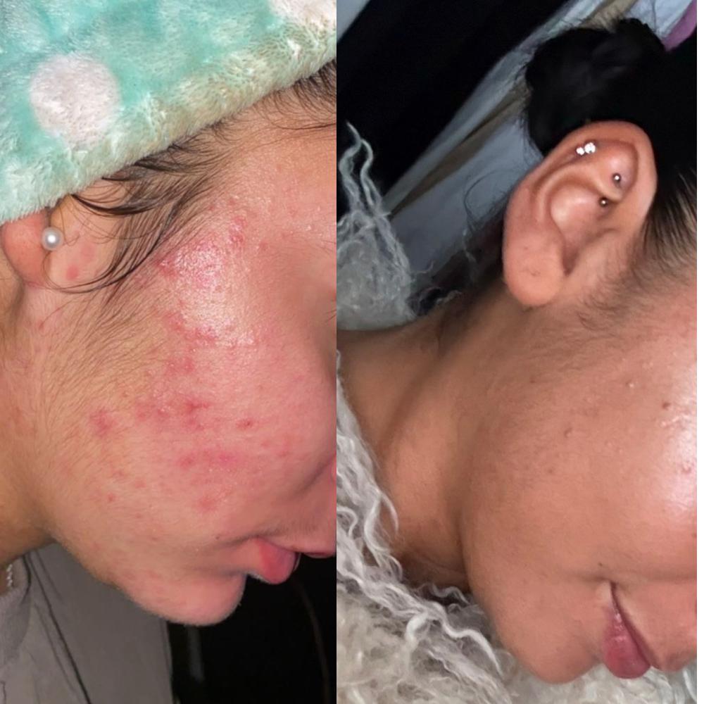 EffaCrème – Crème anti-acné & anti-taches à l’acide azélaïque