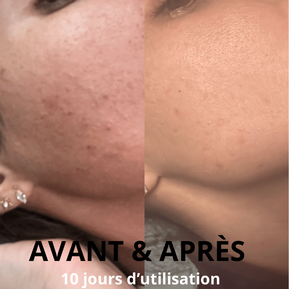 Savon Anti imperfection