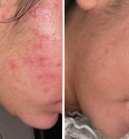 EffaCrème – Crème anti-acné & anti-taches à l’acide azélaïque