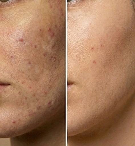 EffaCrème – Crème anti-acné & anti-taches à l’acide azélaïque