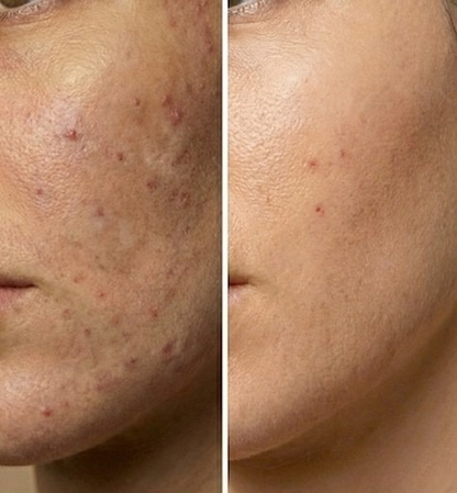 EffaCrème – Crème anti-acné & anti-taches à l’acide azélaïque